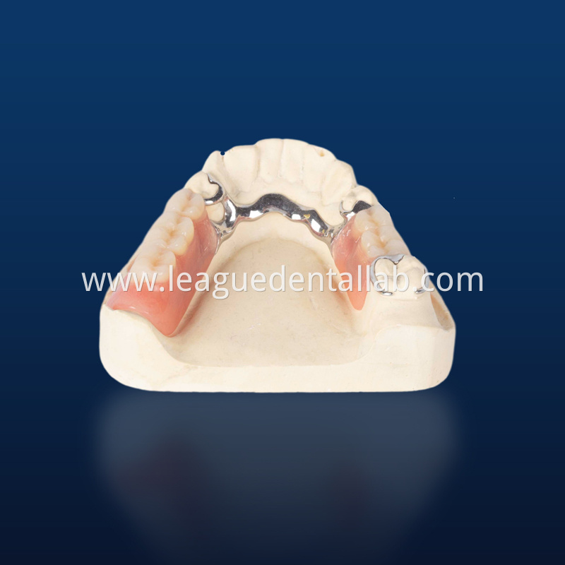 Cast partial,3D printed metal partial,Bego metal partial,cast metal framework,Vatalium Metal framework Cast partial,3D printed metal partial,Bego metal partial,cast metal framework,Vatalium Metal framework